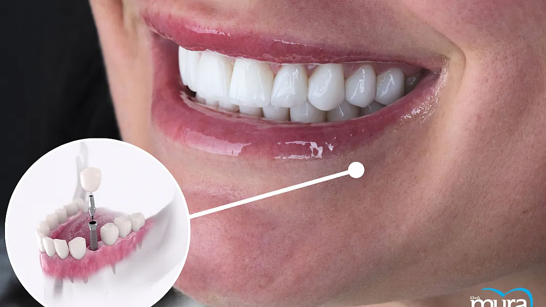 Implant Tedavisinde SGK'nın Kapsamı Genişliyor