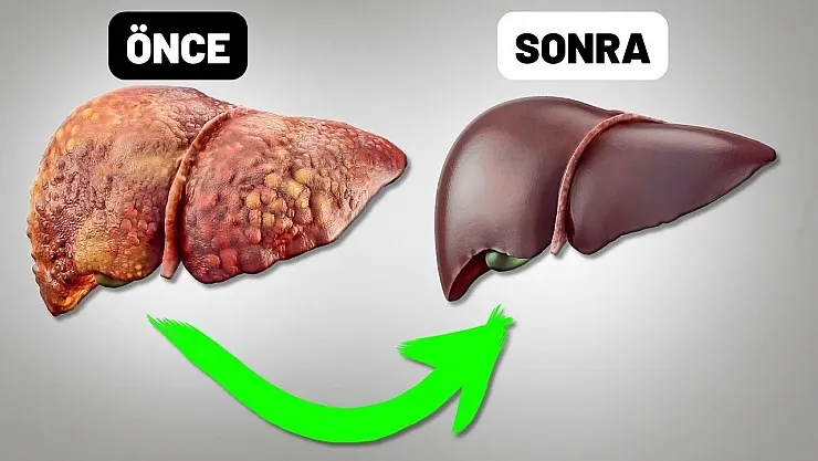 Tıp dünyası şokta alternatif tıp yeni yöntem geliştirdi! Bu adımları yaparak karaciğerinizi temizleyebilirsiniz! İşte o yöntem