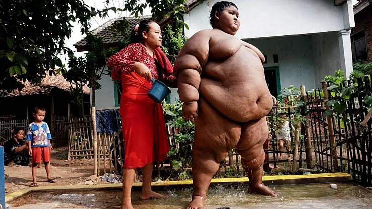 Dünyanın en şişman çocuğu artık zayıfladı! Görenler şok oluyor!