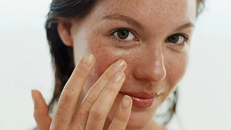 Cilt lekesi sorunu olan herkes bu soruya yanıt arıyor! Cilt bariyerini yenilemenin en etkili zamanı