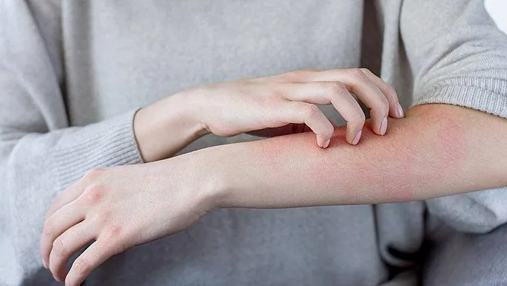 Türkiye'de uyuz vakaları artmaya devam ediyor!