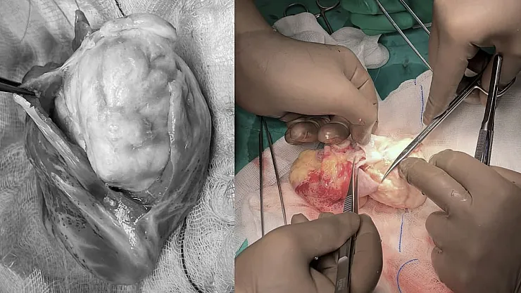 Kalbindeki Tümörü Yenerek Hayata Tutunan Minik Kahraman: Ekin Ada'nın Mucizevi Yolculuğu