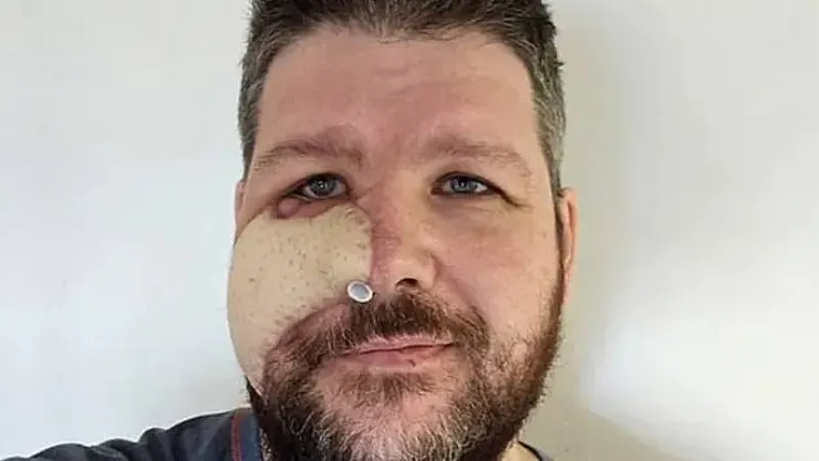 Ayı Saldırdı Yüzü Parçalandı, O ayıdan Taco Yaptı