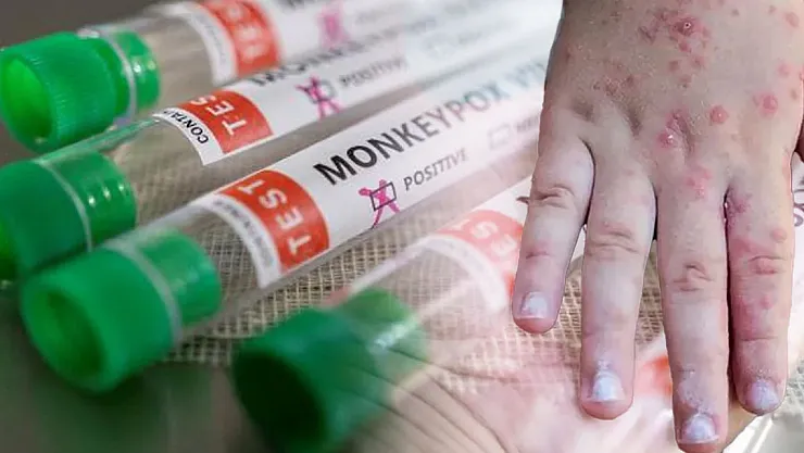 Maymun Çiçeği virüsüne karşı korunaklı olanlar belli oldu! Bu aşıyı olanlar yaşadı