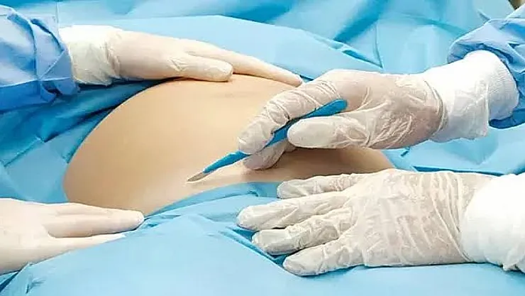 Tıp Merkezlerine sezeryan sınırlaması geldi