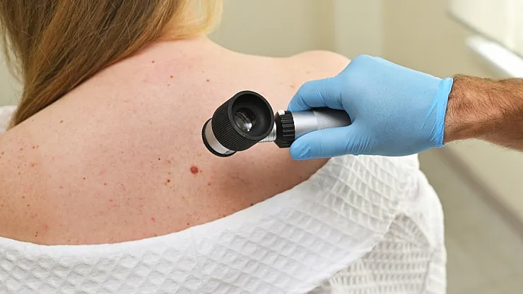 Cilt canserine karşı 37 ilde ücretsiz deri taraması başladı